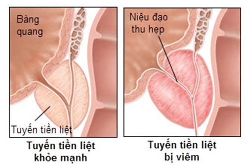 benh-biem-tuyen-tien-liet