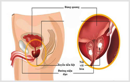 voi-hoa-tuyen-tien-liet